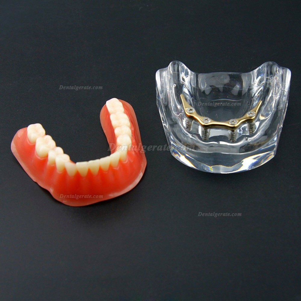 Dental Overdenture Typodont Modell Minderwertiges Pr&auml;zisionsimplantat Golden 6009